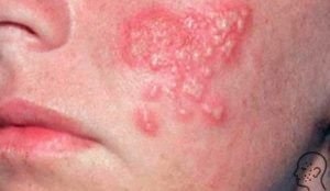 Herpesul pe față - cum se vindecă rapid cauzele și simptomele