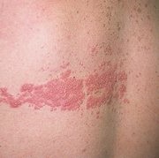 Herpes la talie cum ar fi fotografie, tratament