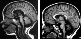 Hipoplazia simptomelor și tratamentului corpus calosum, online sănătoasă