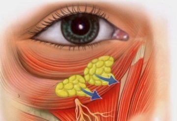 Hernia pleoapei inferioare cum se îndepărtează și se tratează o hernie sub ochi