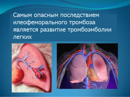 Tromboza tromboembolară - cauze, simptome, diagnostic, tratament, extremități inferioare, μB-10