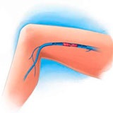 Tromboza tromboembolară - cauze, simptome, diagnostic, tratament, extremități inferioare, μB-10