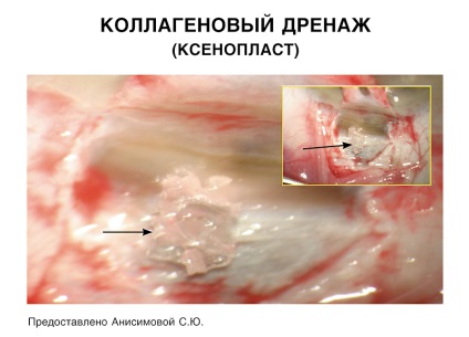 Editura April - Chirurgie de drenaj a glaucomului