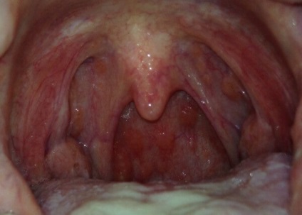 Hogyan kezeljük a pharyngitis-ot otthonában?