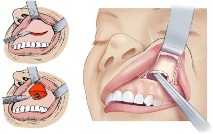 Chistul sinusului maxilar, simptome, patologii, metode de tratament