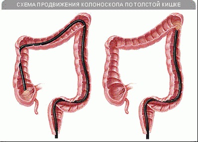 Colonoscopia, spitalul clinic nr. 122, numit după ovarul agenției federale biomedicale