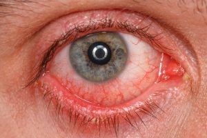Conjunctivita oculară - cauze, simptome și tratament la adulți