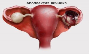 Sângerarea în chistul ovarian Simptom, diagnostic și remedii