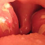 Tratamentul durerilor în gât