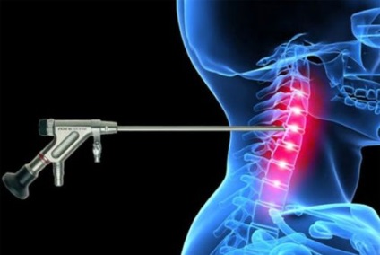 Tratamentul herniei coloanei vertebrale cervicale, cum se trateaza tratamentele populare