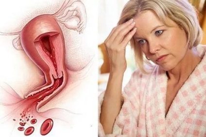 Tratamentul sângerării uterine în premenopauză - metode de tratament în ginecologie