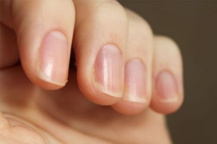 Tratamentul alegerii unghiilor psoriazice ale unghiilor, unghiile frumoase - completează imaginea