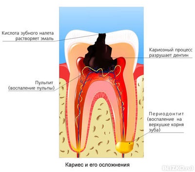 A pulpitis árának kezelése