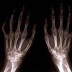 Tratamentul artritei reumatoide cu remedii folclorice și nutriție