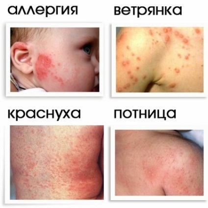 Tratamentul varicelei la copii la domiciliu