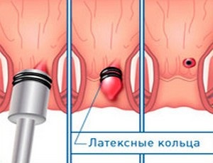 Ligarea hemoroizilor cu inele de latex