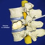 Metode minim invazive de tratare a durerii de spate