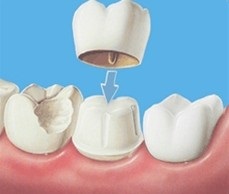 A fém kerámiák a fogászatban az, amivel létrehoztuk a mosolyátokat