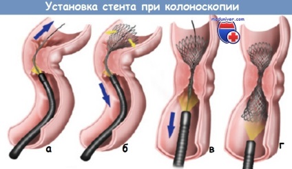 Tehnica de instalare a unui stent în colon la colonoscopie