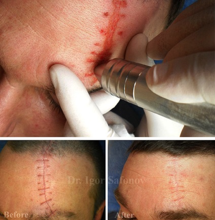 Dermabraziunea mecanică a feței - un impact profund asupra cicatricilor