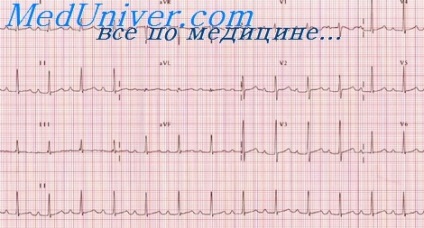 Insuficiență cardiacă cu tirotoxicoză