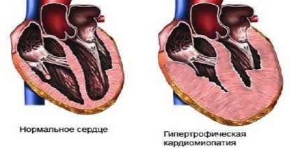 Miocardul necompact al ventriculului stâng și al celui drept, simptome și tratament