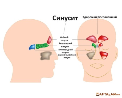 Sinuzită acută și sinuzită cronică