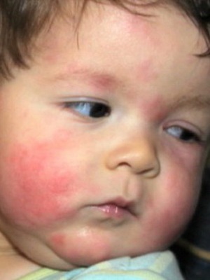Alimente alergice la copii fotografii cu simptome alergice alimentare la copii și cum să tratăm boala