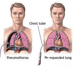 Pneumothorax - okok, kezelések, elsősegélynyújtás