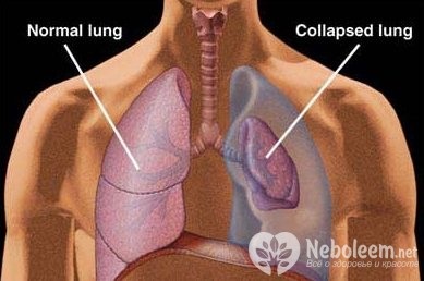 Pneumotorax - cauze, tratament, prim ajutor