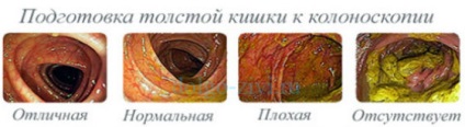 Pregatirea pentru colonoscopia intestinelor determina acuratetea diagnosticului