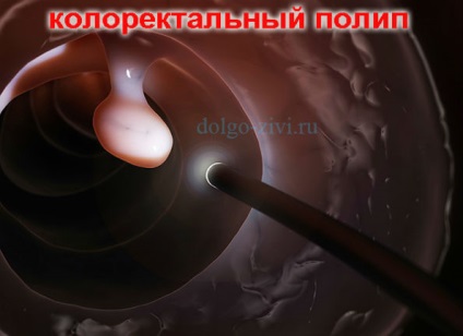 Pregatirea pentru colonoscopia intestinelor determina acuratetea diagnosticului