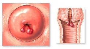 Polipi pe cervix - tratament și eliminare, probleme de infertilitate masculină și feminină și metodele acestora