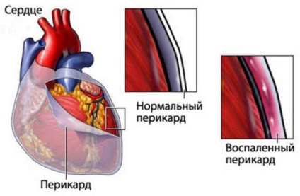 Pneumonie pneumatică pneumatică la adulți și copii în mB-10 - simptome și tratament al focarului,