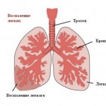 Pneumonie pneumatică pneumatică la adulți și copii în mB-10 - simptome și tratament al focarului,