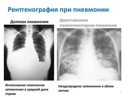 Pneumonie pneumatică pneumatică la adulți și copii în mB-10 - simptome și tratament al focarului,