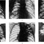 Pneumonie pneumatică pneumatică la adulți și copii în mB-10 - simptome și tratament al focarului,