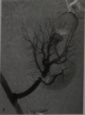 Stenoza post-transplant a arterei renale