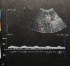 Stenoza post-transplant a arterei renale