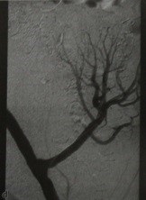 Stenoza post-transplant a arterei renale