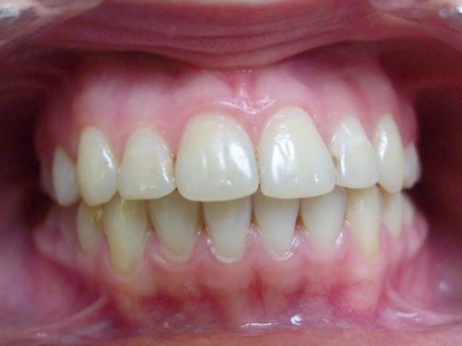 O mușcătură corectă a dinților, așa cum arată