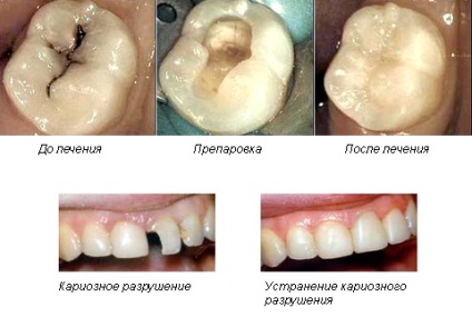 Cauzele cariilor dentare de la care apare pe dinți