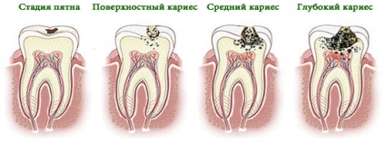 Cauzele cariilor dentare de la care apare pe dinți