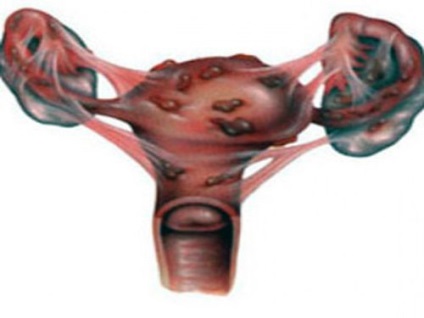 Utilizarea contraceptivelor orale conduce la scăderea parametrilor rezervei ovariene