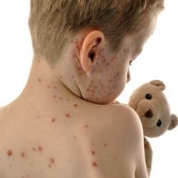 A csirke pox megelőzése gyermekeknél