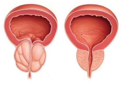 Prostatitis - tratament, simptome, cauze