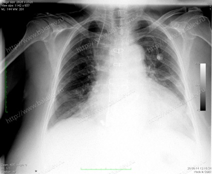 Supapă aortică protetică cu proteze biologice carpentier-edwards perimount