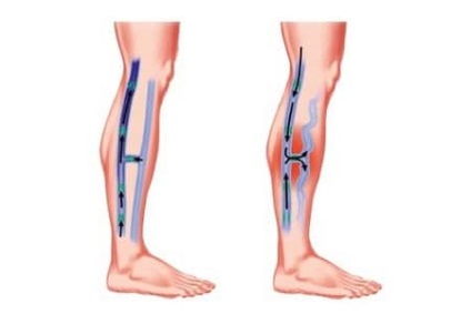 Ptfs ale extremităților inferioare (sindromul postromboflebitic) și cauzele