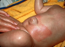 Köldöksérülés újszülöttekben tünetek és kezelés