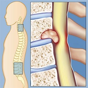 Cancerul simptomelor și tratamentului coloanei vertebrale